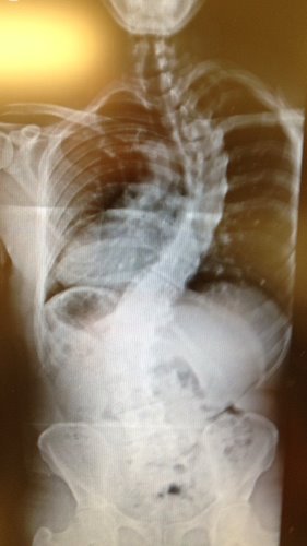 Corey Howard Scoliosis Spine