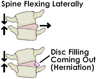 Herniated Disc Basics 2